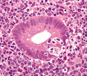 MALT-Lymphom